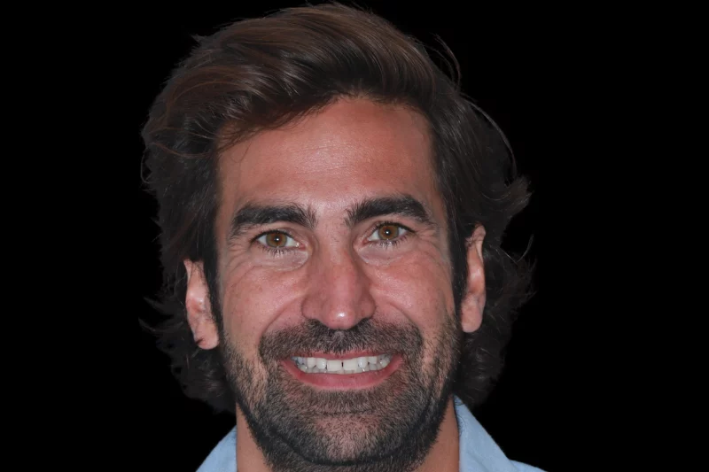 BEFORE NO SHAVE VENEERS