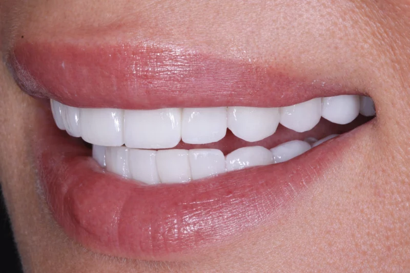 After No shave porcelain veneers in london by dr aleem natural looking results