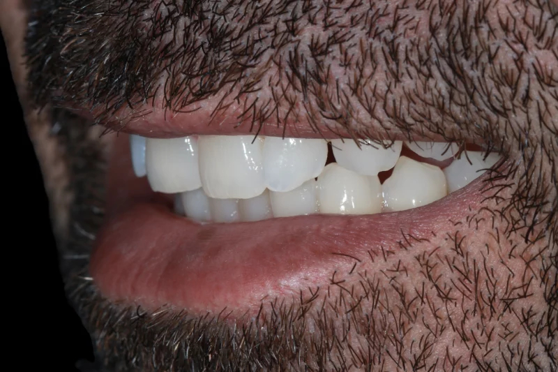 before veneers natural smile