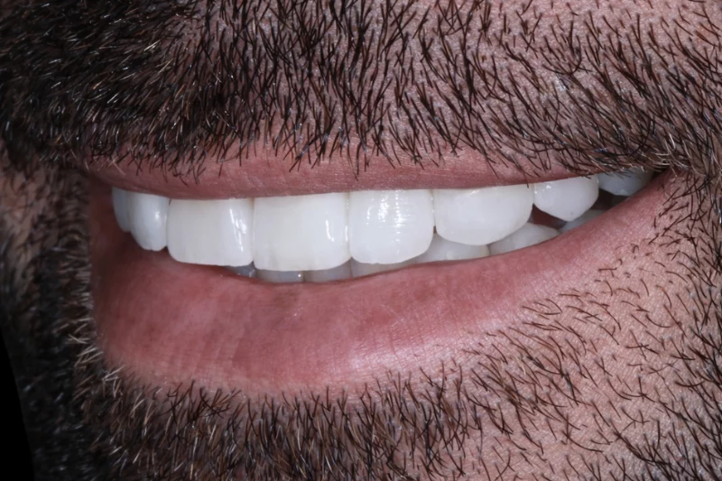 after no shave veneers in london