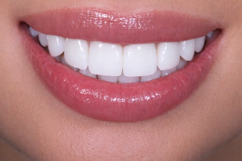 Full Smile Makeover By Dr Aleem with No shave non damaging veneers
