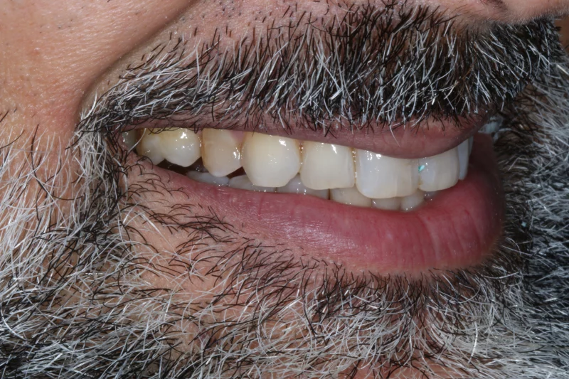 BEFORE VENEERS BEFORE VENEERS
