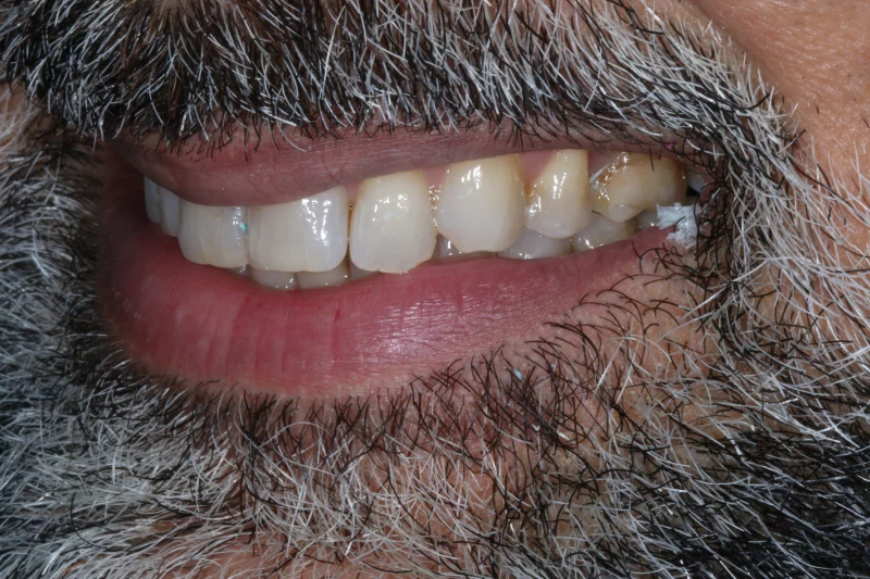 before no cutting veneers before no cutting veneers