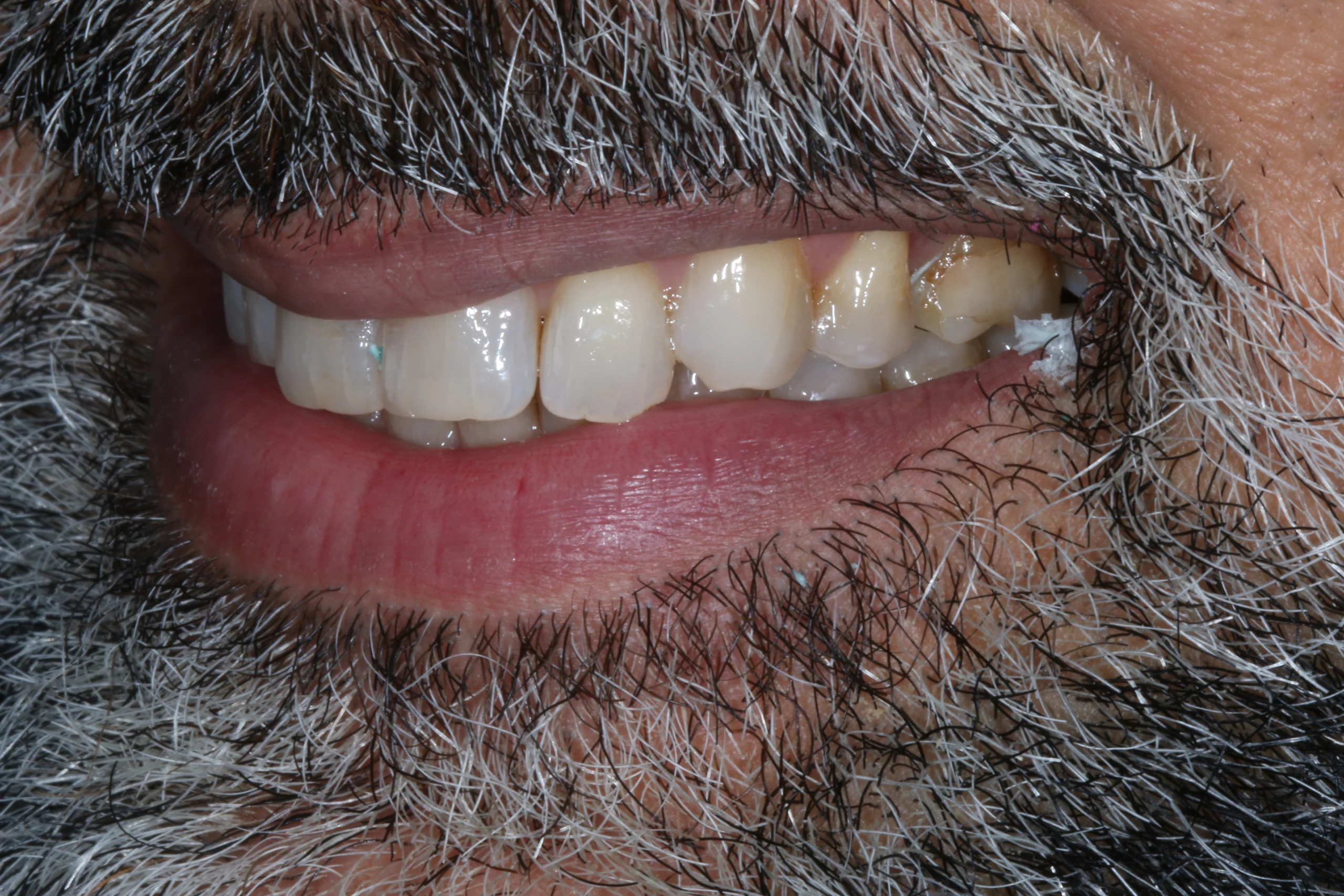 before no cutting veneers