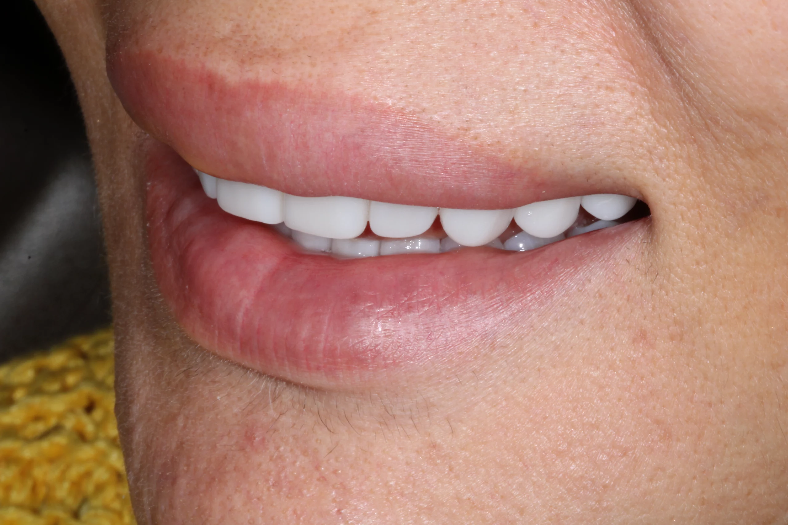 before non cutting veneers