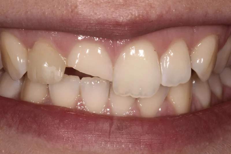 before no prep veneers