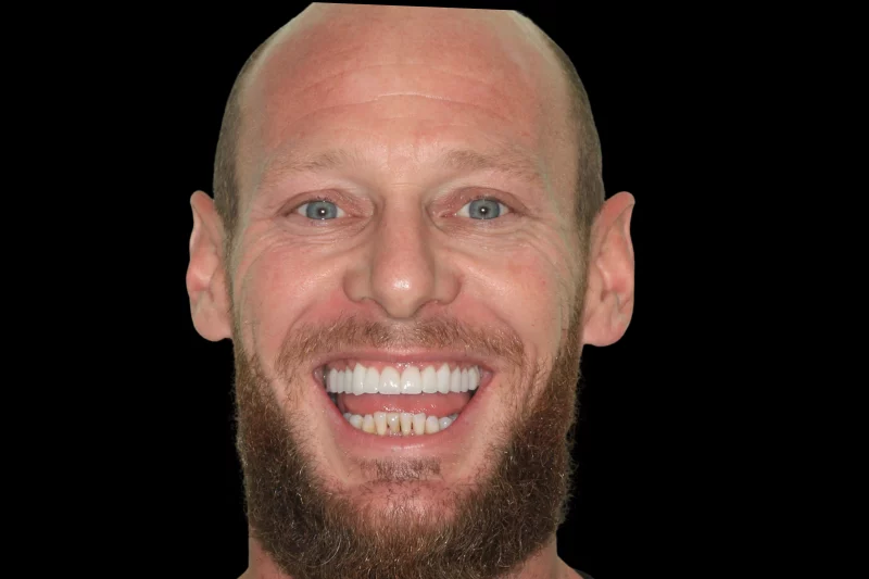 after full arch contact lens veneers