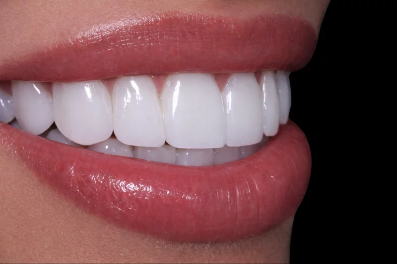 after no shave porcelain veneers