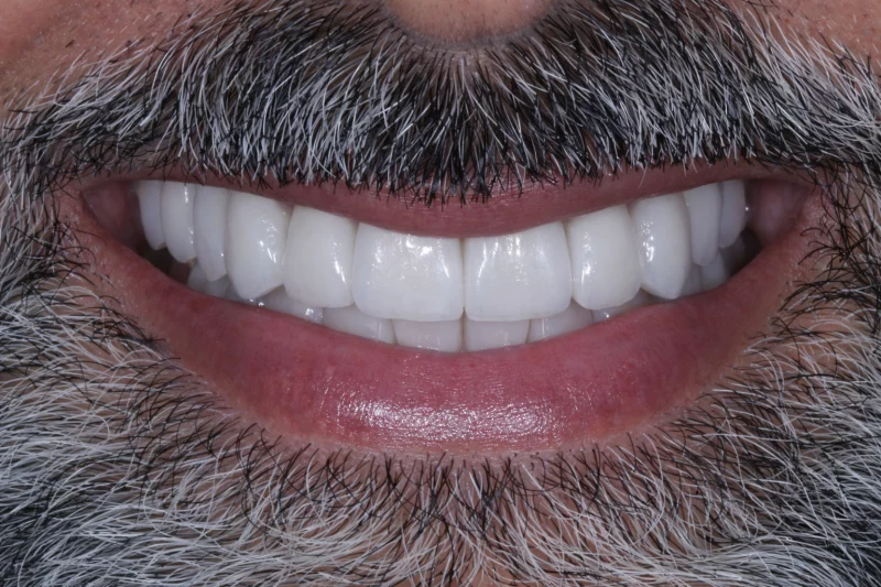 after no shave veneers by dr aleem
