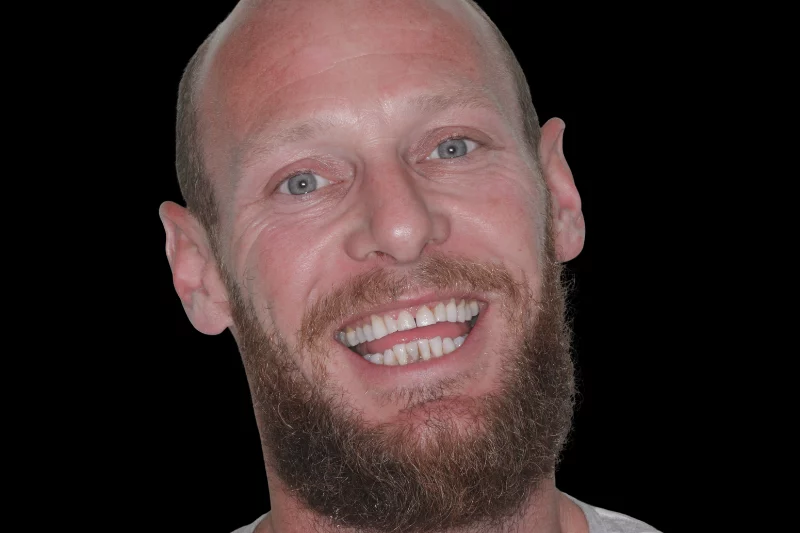 before contact lens veneers