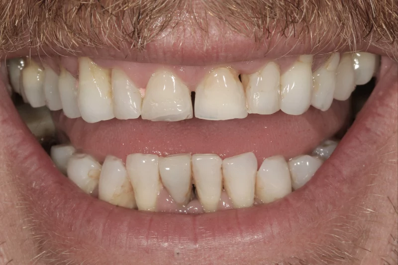before contact lens veneers discolouration, misshapen teeth