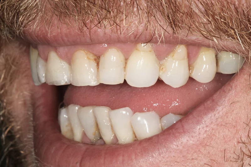 before contact lens veneers