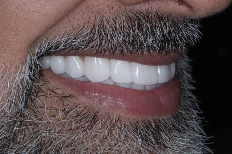 natural looking results with no shave veneers natural looking results with no shave veneers