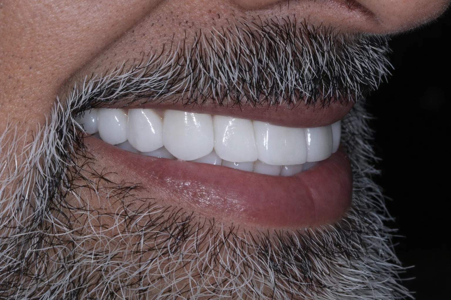 natural looking results with no shave veneers