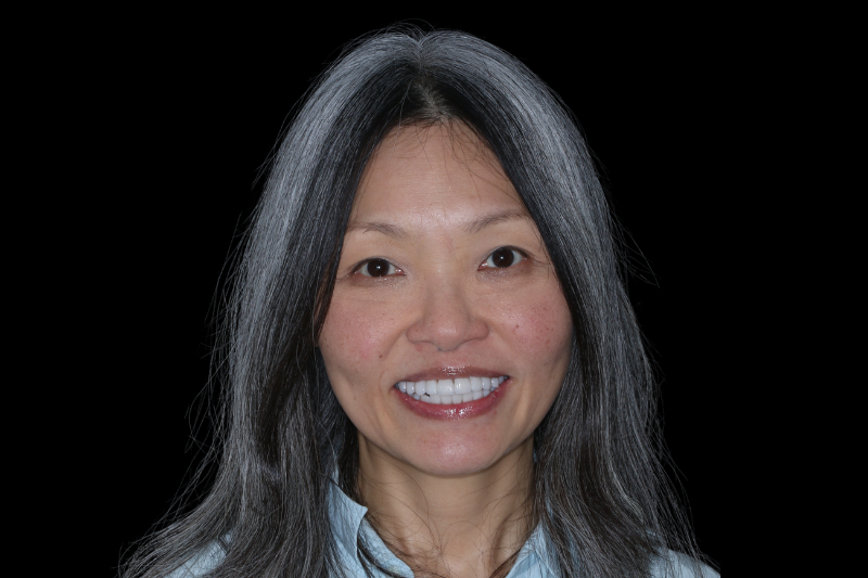 after no shave veneers by dr aleem