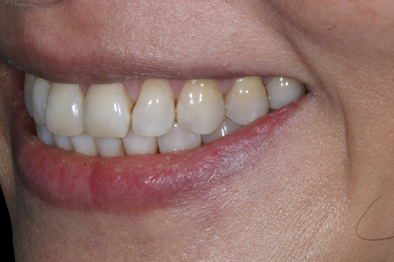 before contact veneers ultra thin no shave veneers by dr aleem