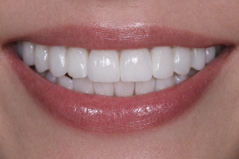 after no prep porcelain veneers