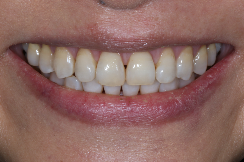 before no shave veneers