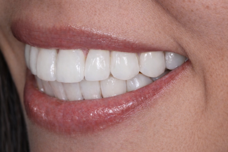 full mouth porcelain veneers contact veneers by dr aleem