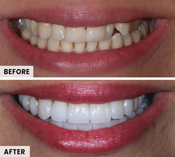 contact lens veneers before and after result 1